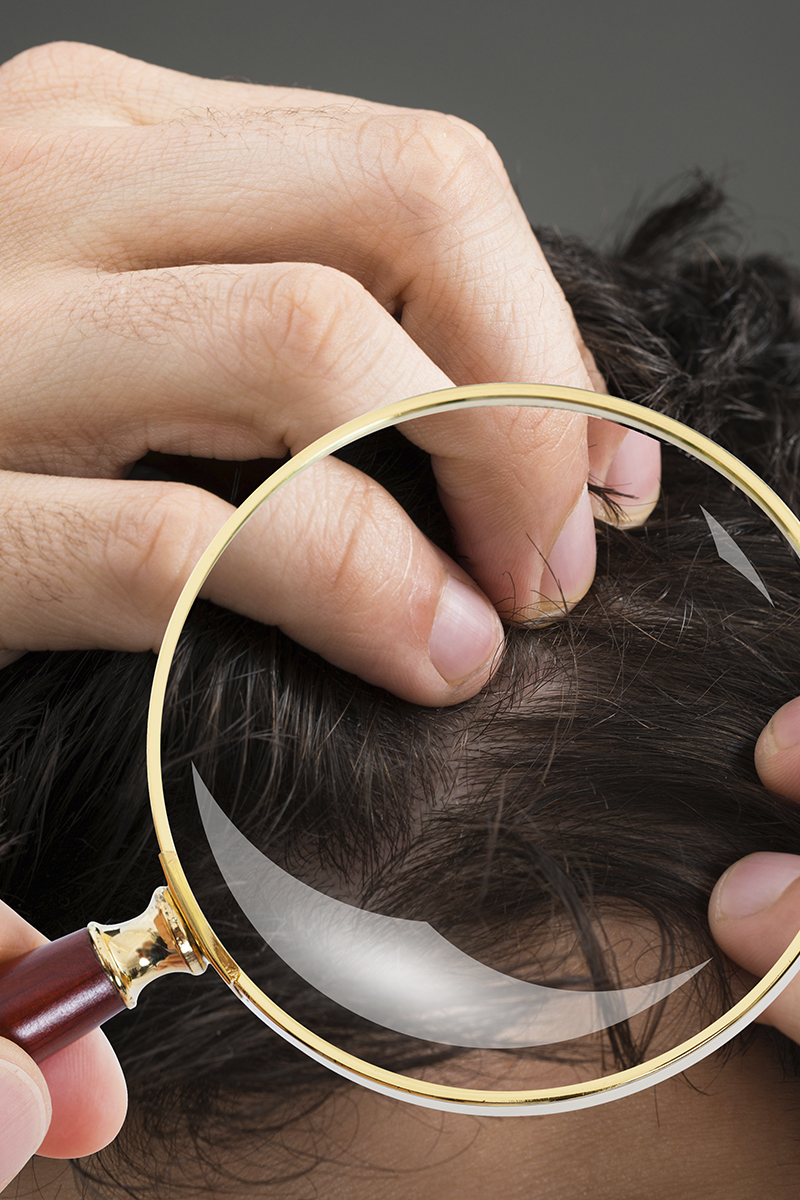 A queda de cabelo pode ser controlada